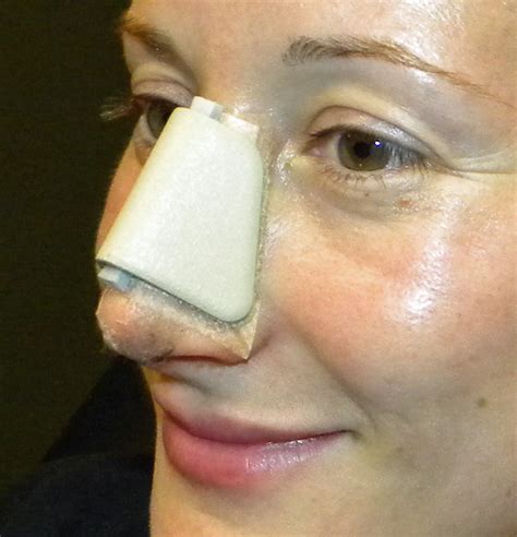I stood in hot shower and let steam and warm water assist with <b>tape</b> but still have sticky spots. . How tight should i tape my nose after rhinoplasty